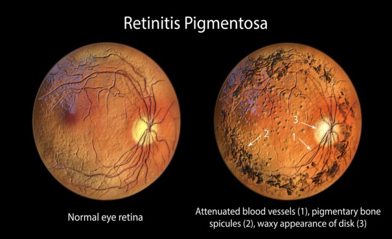 Retinitis Pigmentosa (RP) Treatment