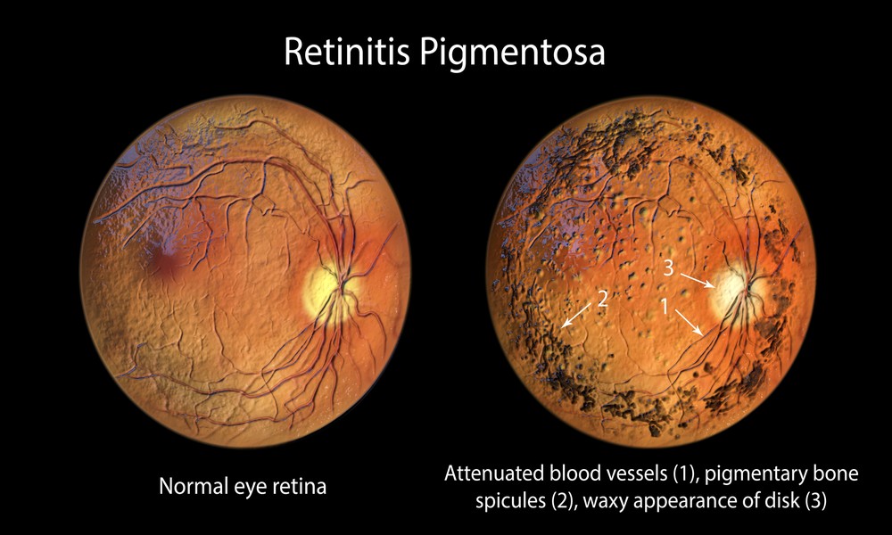 Retinitis Pigmentosa (RP) Treatment
